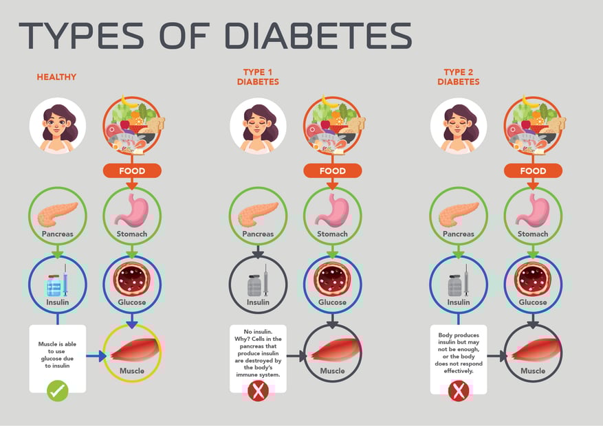 Quick Guide To Safe Exercise For Diabetics